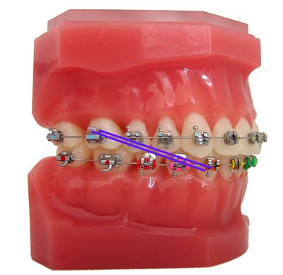 Types Of Orthodontic Appliances In Newtown & Monroe, CT | Baum Braces